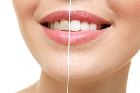 Teeth Whitening Southport Gold Coast Starbright Dental