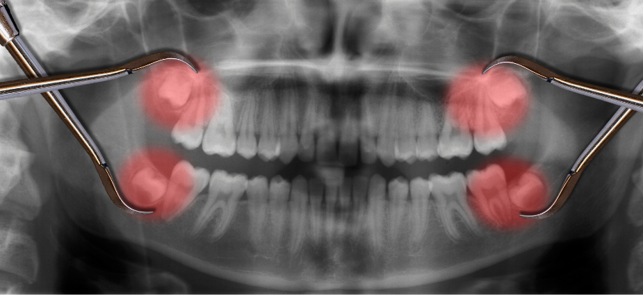 Wisdom Tooth Removal Southport Gold Coast