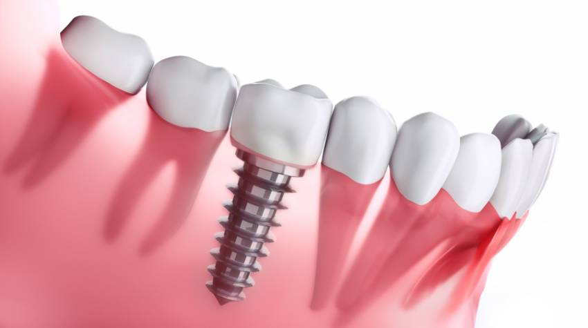 Dental Implants Southport Gold Coast - Southport- Starbright Dental