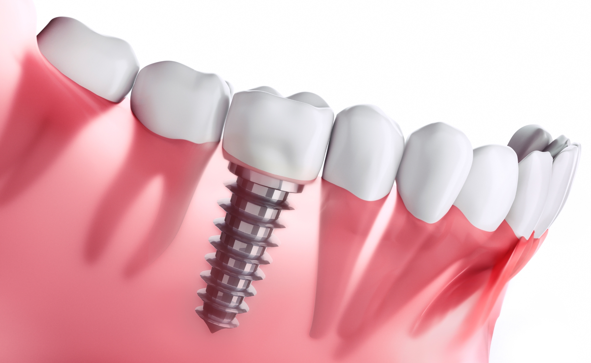 Dental Implants - Starbright Dental Southport Gold Coast