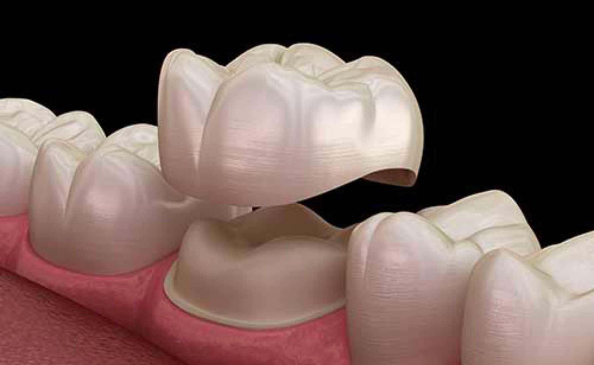 Dental Crowns Blog - Starbright Dental Southport Gold Coast