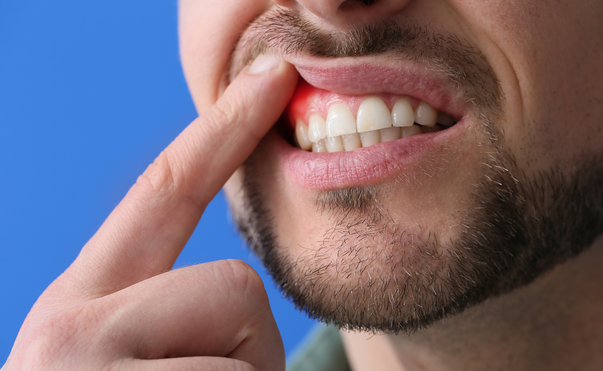 Gum Disease - Starbright Dental Southport Gold Coast
