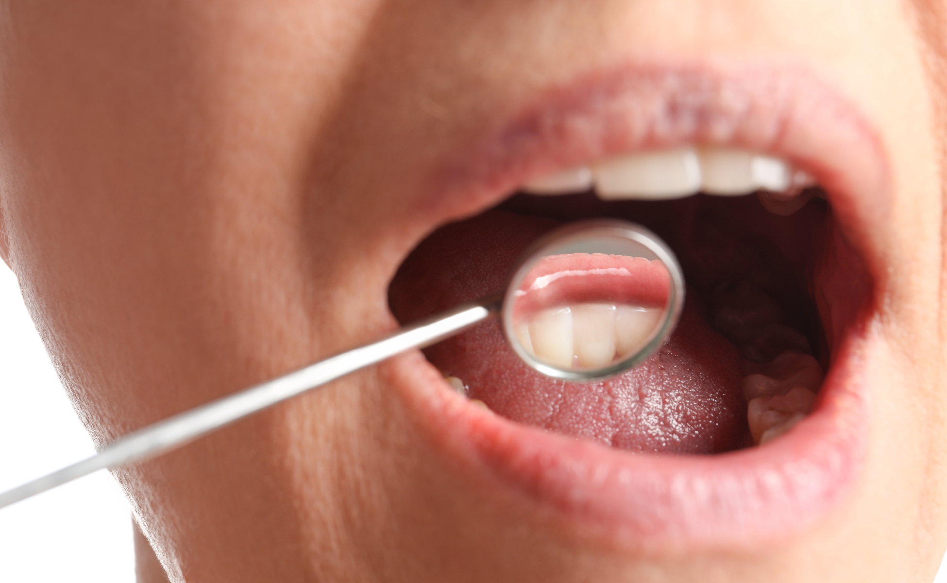 Oral Cancer Awareness: Symptoms, Prevention, and Early Detection
