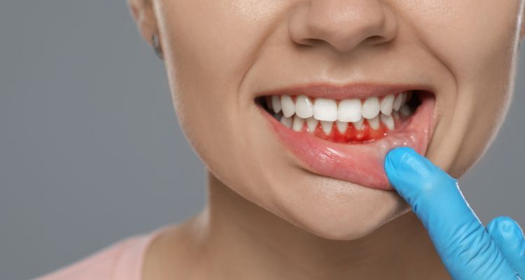 The Stages of Gum Disease From Gingivitis to Periodontitis